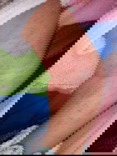 Merah2 di tgn kiri dan kanan