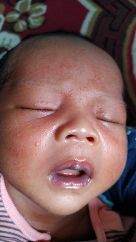 Bunda2 mau tanya ,anak saya ini knp ya merah2 gini. Tdinya sdikit skrg bnyak, minta sarannya bunda2.