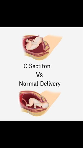 cesarean or normal delivery