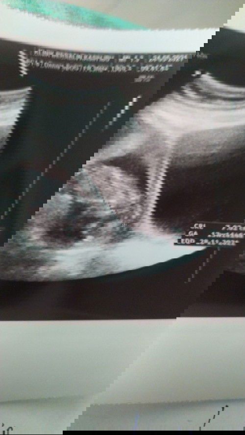 Peranakan turun saat hamil 3 ke 4bulan