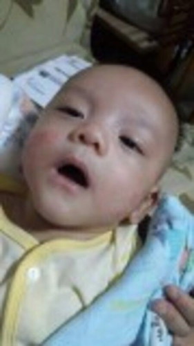 ลูกมีผื่นที่หน้าเยอะ เป็นมาเป็นเดือนแล้ว บางครั้งอากาศร้อนจะแดง และคัน บางทีเกาเลือดไหล ทำยังไงดีคะ