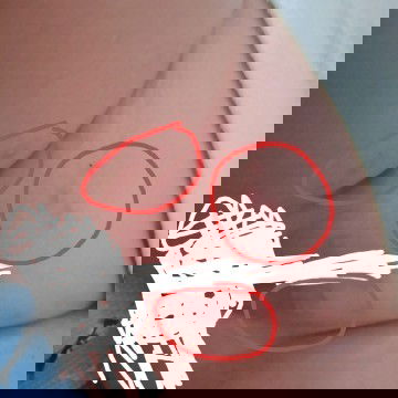 Bisul sekitar alat kelamin