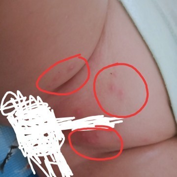 Bisul sekitar alat kelamin