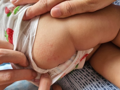 Is this diaper rash?