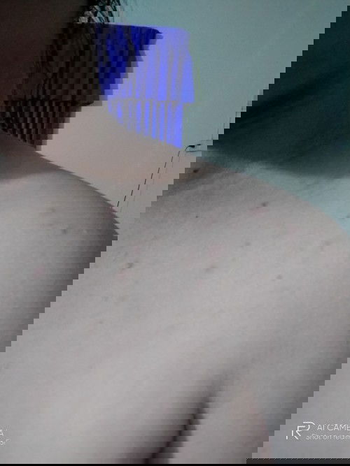 แม่คนไหนท้องแล้วมีตุ่มเล็กๆแดงๆขึ้นแบบนี้มั้ยค่ะ พออากาสร้อนมากๆมันจะคัน