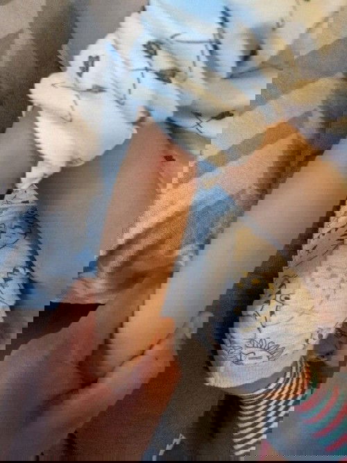 Red spots on 1 year old arms and face. Anyone experienced similar issue?