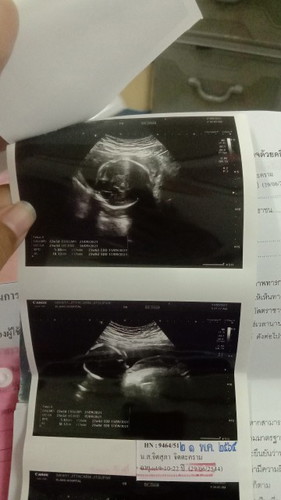 มีใครมองรูปอัลตร้าซาวด์ของลูกตัวเองไม่ออกบ้างคะ(23W)