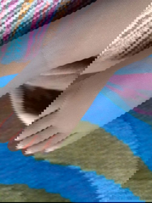 bintik kecil di kaki, tangan, paha dan bagian perut