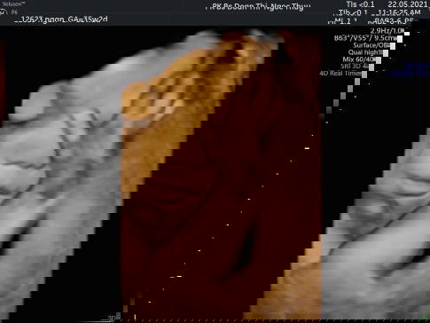 Mình buồn quá. 35tuần thai 2ki2. Bsi bảo nhỏ quá. K biết sao cho nhanh lên kí nữa.. có ai TV giúp mi