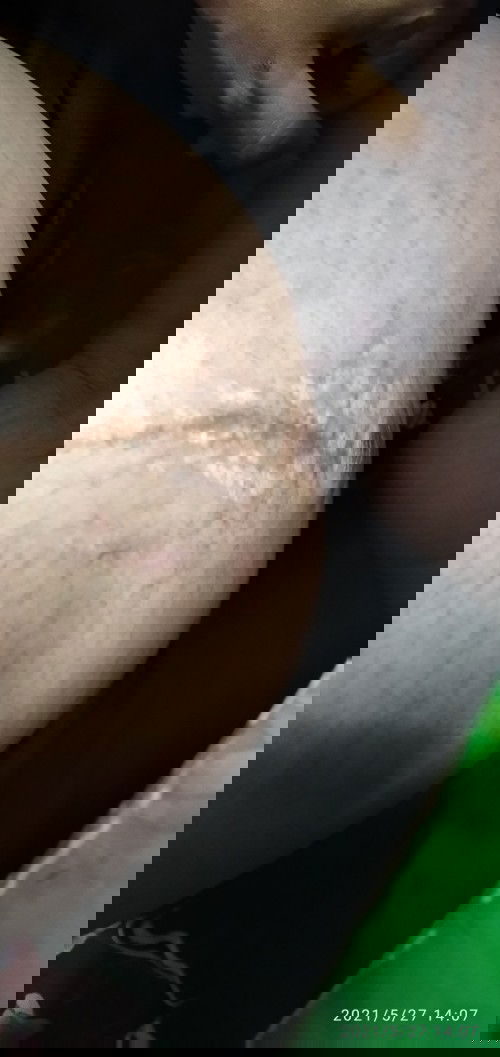 แบบนี้หรือป่าวที่เค้าเรียกว่าท้องแตกลาย