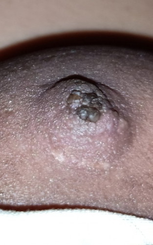 DRY NIPPLE AT 7MOS.