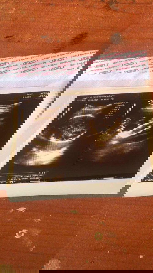 Hasil USG ,
Kmrin di UsG katanya anak ku kelilit tali pusar,tapi aku brhrap lahiran normal minta doanya ya bunda” 😢🙏🙏