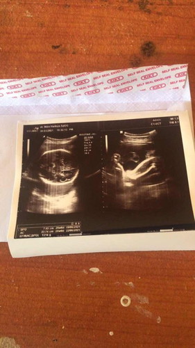 Hasil USG ,
Kmrin di UsG katanya anak ku kelilit tali pusar,tapi aku brhrap lahiran normal minta doanya ya bunda” 😢🙏🙏