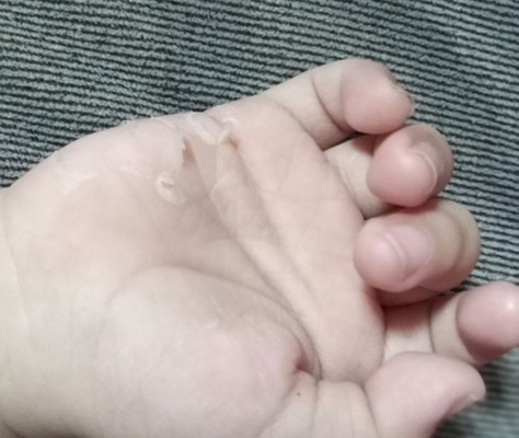 Any idea bakit nagbabalat ang palad ni baby? Is it vitamin deficiency?