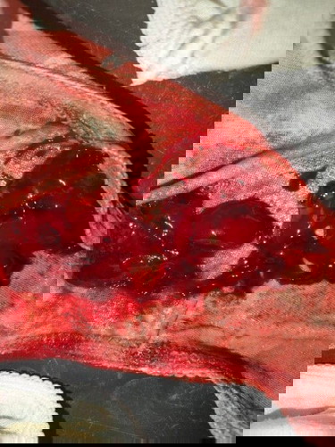 BLEEDING DURING PREGNANCY