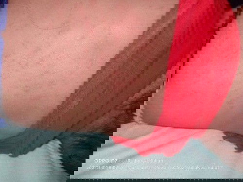 Biang keringat pada bayi