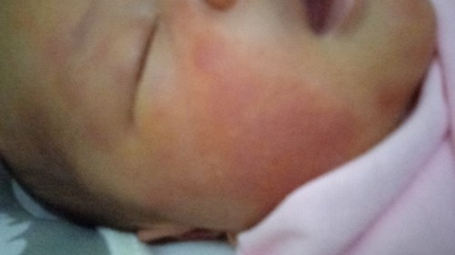 Pipi bayi baru lahir 4 hari kenapa merah gatel obatnya apa ya??