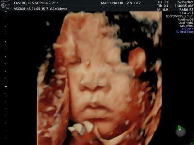 3D/4D ultrasound