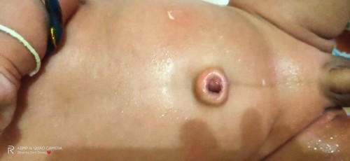Granuloma umbilikalis