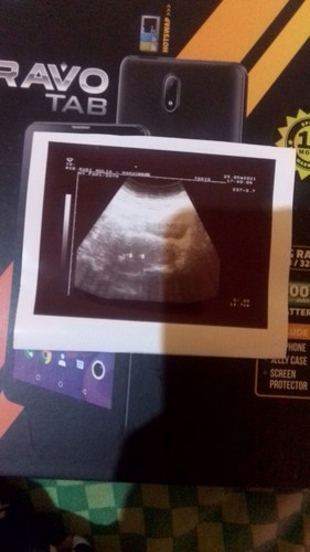 Dok ini artix apa ya dokter,apakah aku hamil?