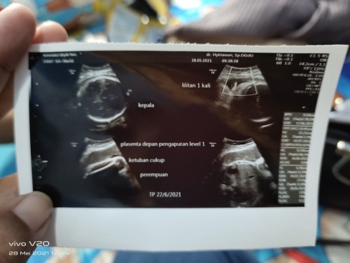 Usia kehamilan 36w3d