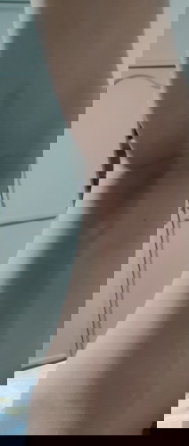 Discoloration sa legs