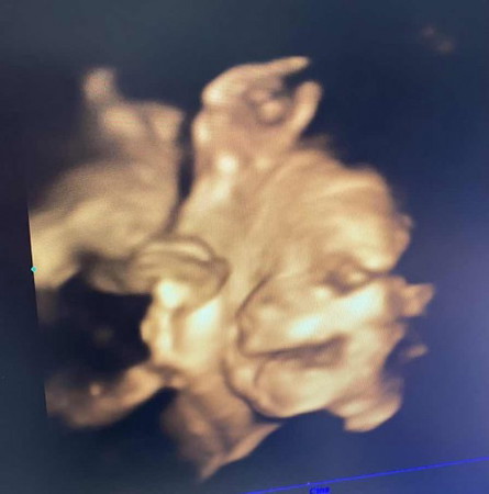ท้องได้ 7 เดือนลูกกลับหัว เอาหัวลงแล้วค่ะ แม่ๆ ท่านอื่นลูกกลับหัวกันตอนกี่เดือนคะ