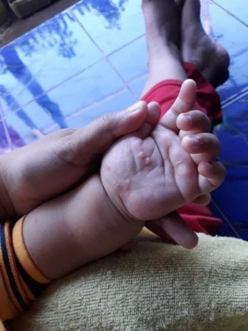 Konsultasi pada dr rina diana winta masalah ruam bayi