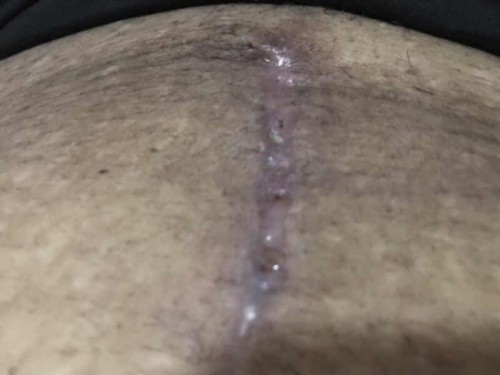 แผลผ่าคลอด 16 วันแล้ว แต่ยังมีน้ำออก ปกติมั้ยค่ะ