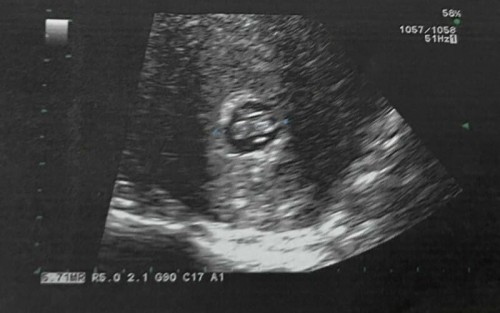 ❌น้องไม่อยู่แล้ว 28/5/64 @23.30❌
ตั้งครรภ์ 7 สัปดาห์ 4 วัน มีอาการปวดท้องน้อยและมีเลือดออก