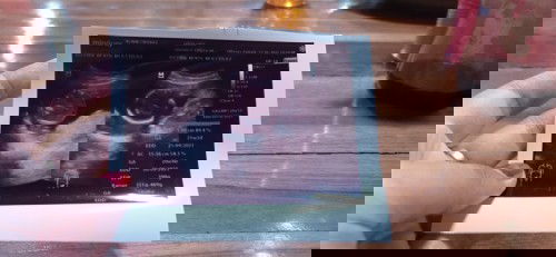 Ini hsil usg  pas 21 minggu
Dn skarng udh 23 minggu
21 minggu bert jnin 390g normal/kebesaran yah?