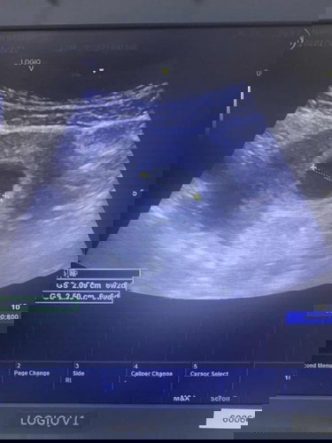 อายุครรภ์ไม่ตรงกับกับเครื่องซาวน์