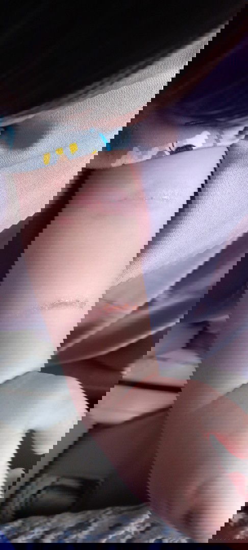 Mau nanya dong moms,,obat untuk kulit kek gini apa yah??
Udah kasih baby oil,,