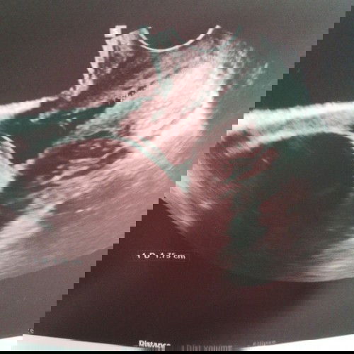 Pa help naman po para sa Y shaped Cervical ko