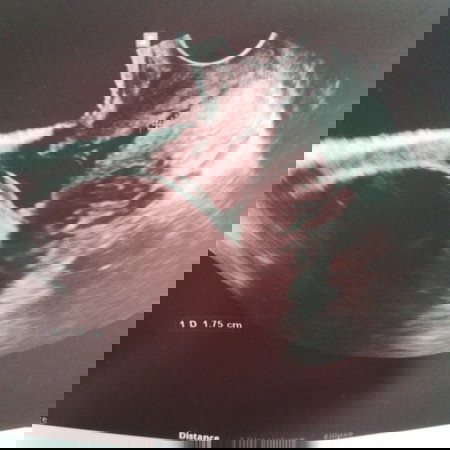 Pa help naman po para sa Y shaped Cervical ko