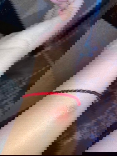 เเม่ๆบ้านไหนเป็นเเบบนี้บ้างคะอยู่ๆก็มีเเผลขึ้นมีน้ำหนองปวดด้วย ปกติมั้ยคะ