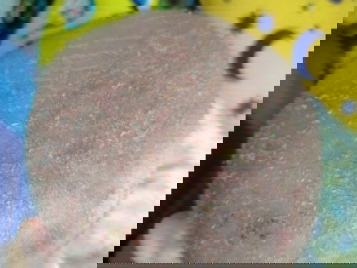 Kulit kepaal terkelupas