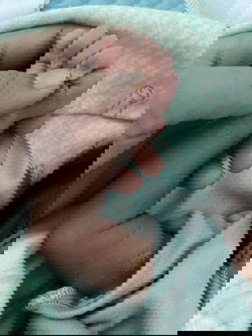 Biang keringat bernanah