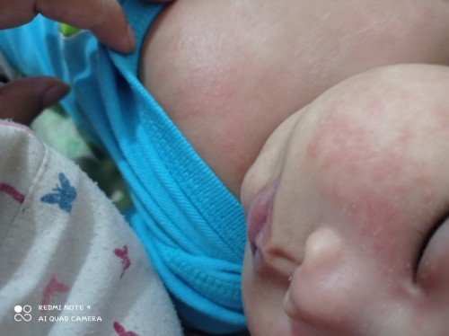 Muka merah dan gatal