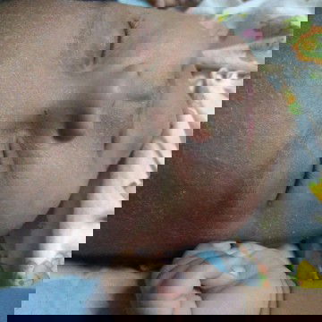 ขอคำแนะนำหน่อยนะคะคือตอนแรกที่หน้าน้องเป็นผดร้อนบวกกับโดนน้ำนมแม่ตอนนี้หน้าแห้งคันรักษาแบบไหนได้คะ