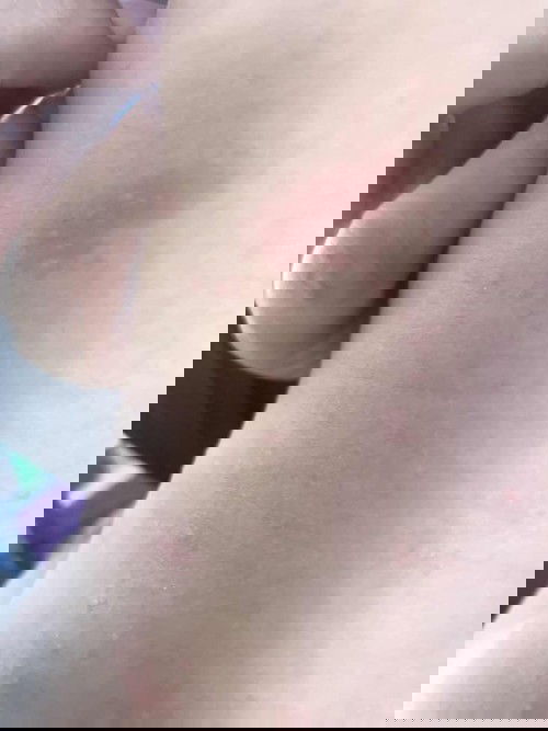 ผดผื่นมนเด็กทารก