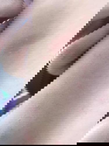 ผดผื่นมนเด็กทารก