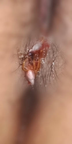 Labas ang tahi normal delivery