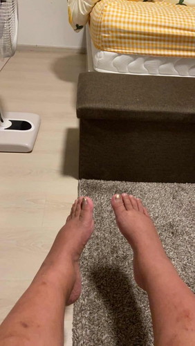 ครรภ์แฝด สัปดาห์ที่ 35 ขาบวมเก่ง กินหวานเก่ง