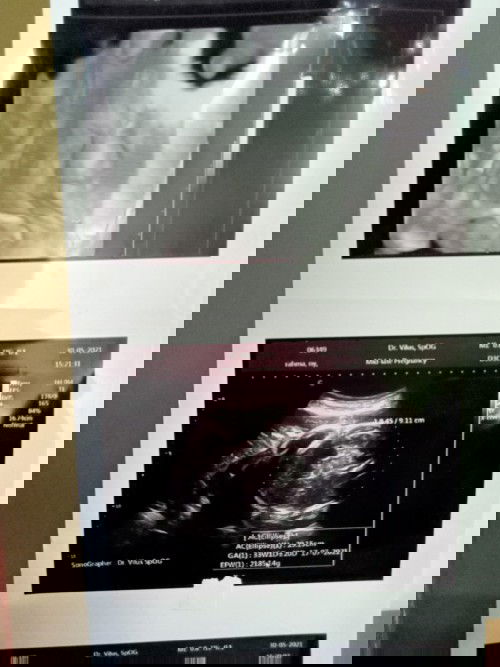 Mungkinkah hasil USG salah?