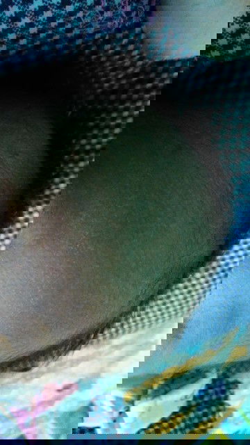 Dahi berbintik&berair bening