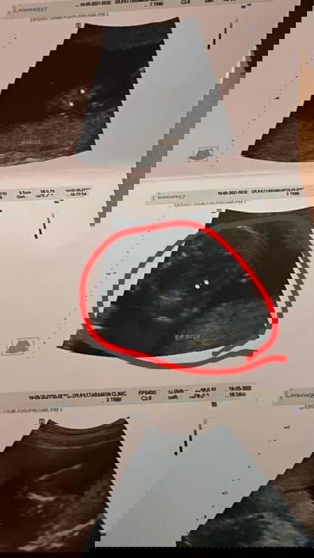 ปรึกษาหน่อยค่ะหรือใครพอจะมีประสบการณ์คล้ายๆกันบ้างมั้ยคะ😂