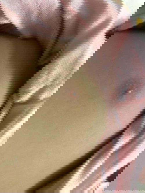 Trẻ nhỏ bị nổi mình đầu ti