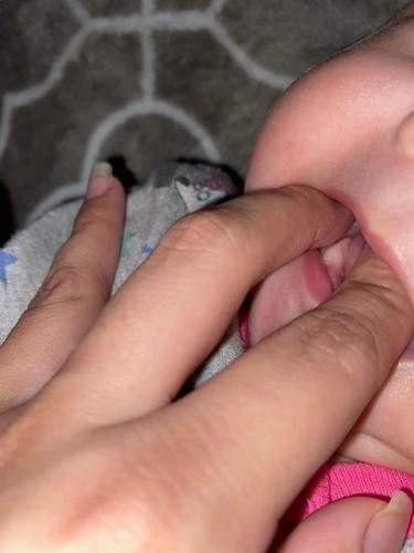 White spots on baby’s gums (back of mouth)