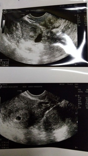 Scan 7 minggu belum nampak baby dalam kantung.adakah kandungan saya bermasalah?